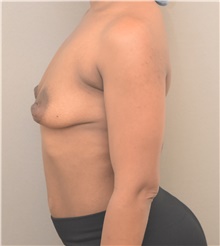 Breast Lift Before Photo by Keshav Magge, MD; Bethesda, MD - Case 46023