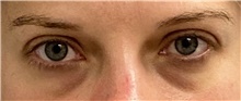 Eyelid Surgery Before Photo by Keshav Magge, MD; Bethesda, MD - Case 46031