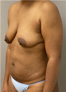 Breast Lift Before Photo by Keshav Magge, MD; Bethesda, MD - Case 46033
