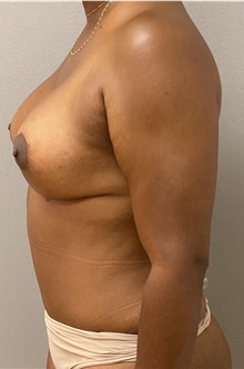 Breast Lift After Photo by Keshav Magge, MD; Bethesda, MD - Case 46033