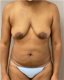 Tummy Tuck Before Photo by Keshav Magge, MD; Bethesda, MD - Case 46034