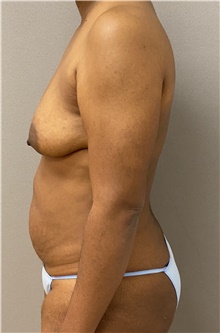 Tummy Tuck Before Photo by Keshav Magge, MD; Bethesda, MD - Case 46034