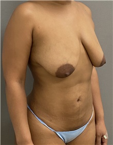 Breast Lift Before Photo by Keshav Magge, MD; Bethesda, MD - Case 46149