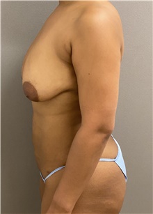 Breast Lift Before Photo by Keshav Magge, MD; Bethesda, MD - Case 46149
