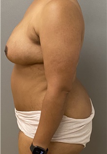Breast Reduction After Photo by Keshav Magge, MD; Bethesda, MD - Case 46150