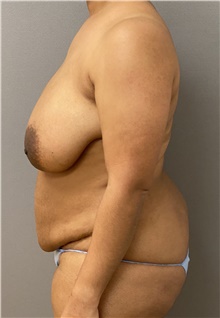 Breast Reduction Before Photo by Keshav Magge, MD; Bethesda, MD - Case 46150