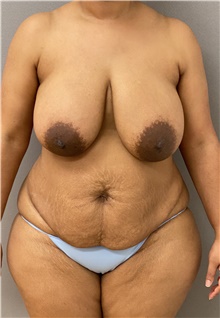 Tummy Tuck Before Photo by Keshav Magge, MD; Bethesda, MD - Case 46151