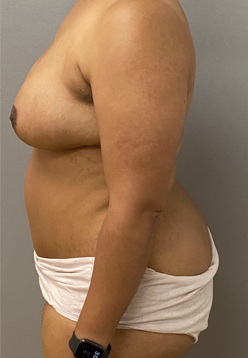 Tummy Tuck Before and After Photos by Keshav Magge, MD; Bethesda, MD - Case  46151