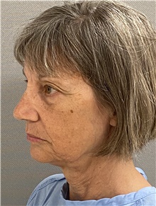 Facelift Before Photo by Keshav Magge, MD; Bethesda, MD - Case 46153