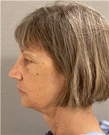 Facelift Before Photo by Keshav Magge, MD; Bethesda, MD - Case 46153