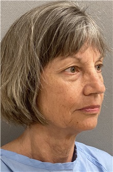 Neck Lift Before Photo by Keshav Magge, MD; Bethesda, MD - Case 46154
