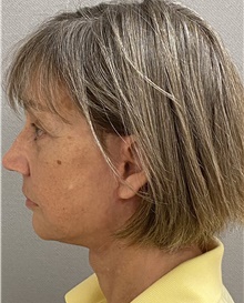 Neck Lift After Photo by Keshav Magge, MD; Bethesda, MD - Case 46154