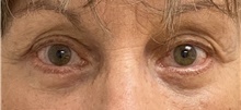 Eyelid Surgery After Photo by Keshav Magge, MD; Bethesda, MD - Case 46156