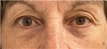 Eyelid Surgery Before Photo by Keshav Magge, MD; Bethesda, MD - Case 46156