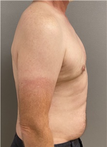 Male Breast Reduction After Photo by Keshav Magge, MD; Bethesda, MD - Case 46157