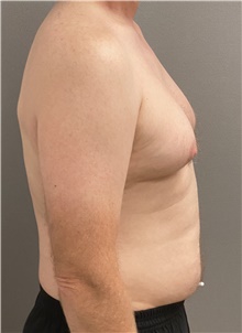Male Breast Reduction Before Photo by Keshav Magge, MD; Bethesda, MD - Case 46157