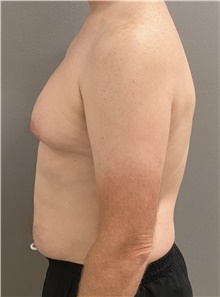 Male Breast Reduction Before Photo by Keshav Magge, MD; Bethesda, MD - Case 46157