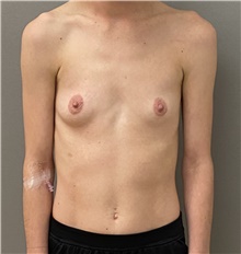 Breast Augmentation Before Photo by Keshav Magge, MD; Bethesda, MD - Case 46224