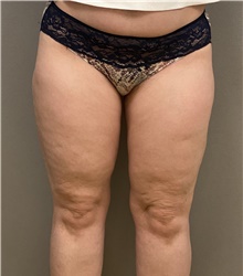 Liposuction After Photo by Keshav Magge, MD; Bethesda, MD - Case 46226