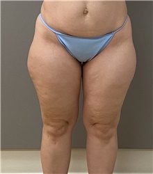 Liposuction Before Photo by Keshav Magge, MD; Bethesda, MD - Case 46226