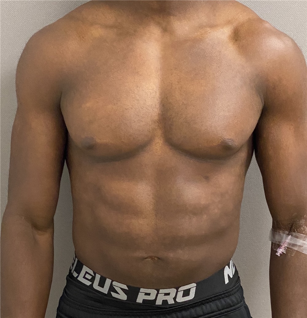 Male Breast Reduction Before and After Photos by Keshav Magge, MD; Bethesda,  MD - Case 46227