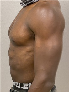 Male Breast Reduction After Photo by Keshav Magge, MD; Bethesda, MD - Case 46227