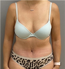 Tummy Tuck After Photo by Keshav Magge, MD; Bethesda, MD - Case 46931