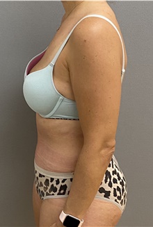 Tummy Tuck After Photo by Keshav Magge, MD; Bethesda, MD - Case 46931