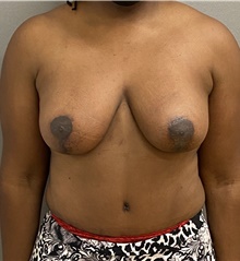 Breast Lift After Photo by Keshav Magge, MD; Bethesda, MD - Case 46932