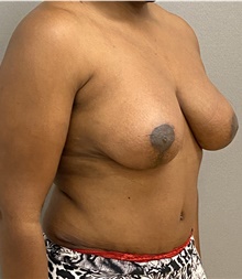 Breast Lift After Photo by Keshav Magge, MD; Bethesda, MD - Case 46932