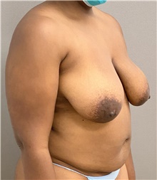 Breast Lift Before Photo by Keshav Magge, MD; Bethesda, MD - Case 46932