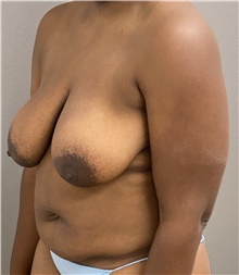 Breast Lift Before Photo by Keshav Magge, MD; Bethesda, MD - Case 46932