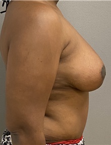 Tummy Tuck After Photo by Keshav Magge, MD; Bethesda, MD - Case 46933