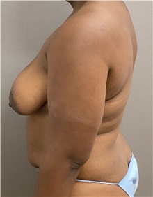 Tummy Tuck Before Photo by Keshav Magge, MD; Bethesda, MD - Case 46933
