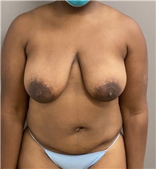 Tummy Tuck Before Photo by Keshav Magge, MD; Bethesda, MD - Case 46933
