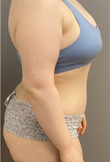 Tummy Tuck After Photo by Keshav Magge, MD; Bethesda, MD - Case 46975