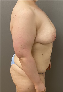 Tummy Tuck Before Photo by Keshav Magge, MD; Bethesda, MD - Case 46975