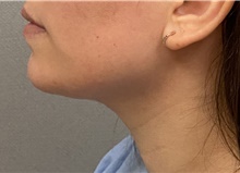 Chin Surgery After Photo by Keshav Magge, MD; Bethesda, MD - Case 47341