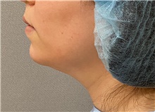 Chin Surgery Before Photo by Keshav Magge, MD; Bethesda, MD - Case 47341