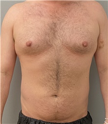 Liposuction Before Photo by Keshav Magge, MD; Bethesda, MD - Case 47343