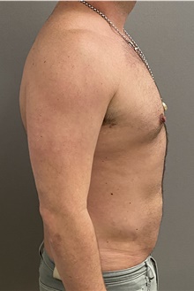 Liposuction After Photo by Keshav Magge, MD; Bethesda, MD - Case 47343
