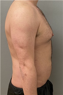 Liposuction Before Photo by Keshav Magge, MD; Bethesda, MD - Case 47343