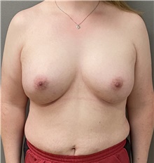 Gender Affirmation Surgery After Photo by Keshav Magge, MD; Bethesda, MD - Case 47345