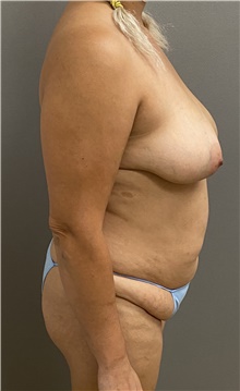 Breast Lift Before Photo by Keshav Magge, MD; Bethesda, MD - Case 47346