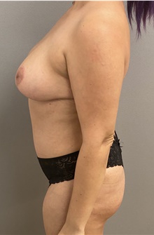 Breast Lift After Photo by Keshav Magge, MD; Bethesda, MD - Case 47346