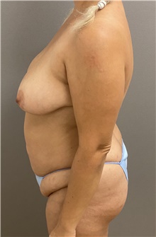 Breast Lift Before Photo by Keshav Magge, MD; Bethesda, MD - Case 47346