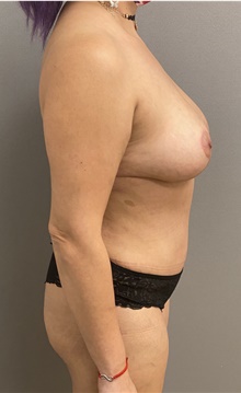 Tummy Tuck After Photo by Keshav Magge, MD; Bethesda, MD - Case 47347