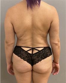Buttock Lift with Augmentation After Photo by Keshav Magge, MD; Bethesda, MD - Case 47349