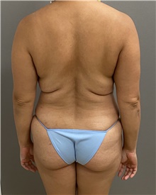 Buttock Lift with Augmentation Before Photo by Keshav Magge, MD; Bethesda, MD - Case 47349