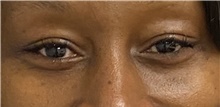 Eyelid Surgery After Photo by Keshav Magge, MD; Bethesda, MD - Case 47351